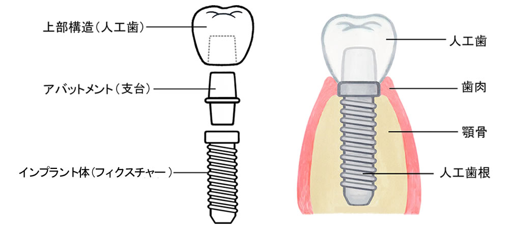 インプラント構造の図解